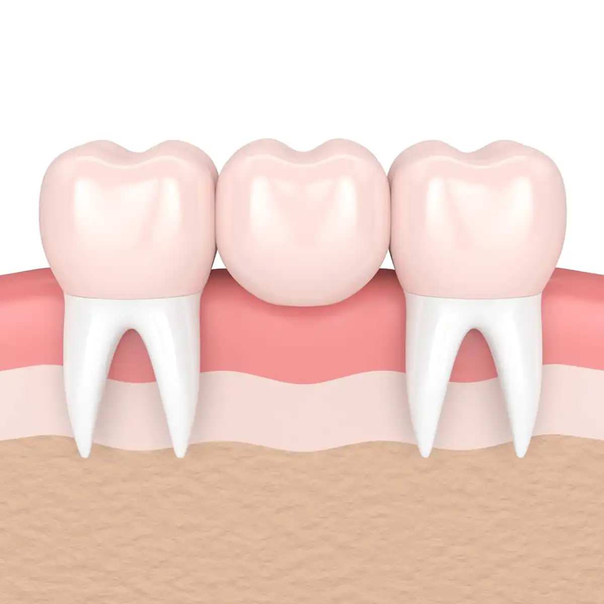 Dental Bridges